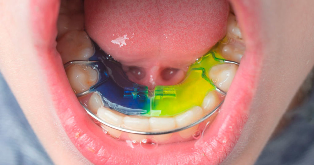 Ortopedia dental infantil