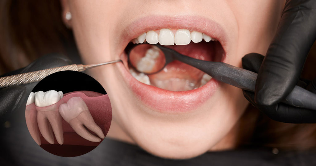Postoperatorio de injerto óseo dental