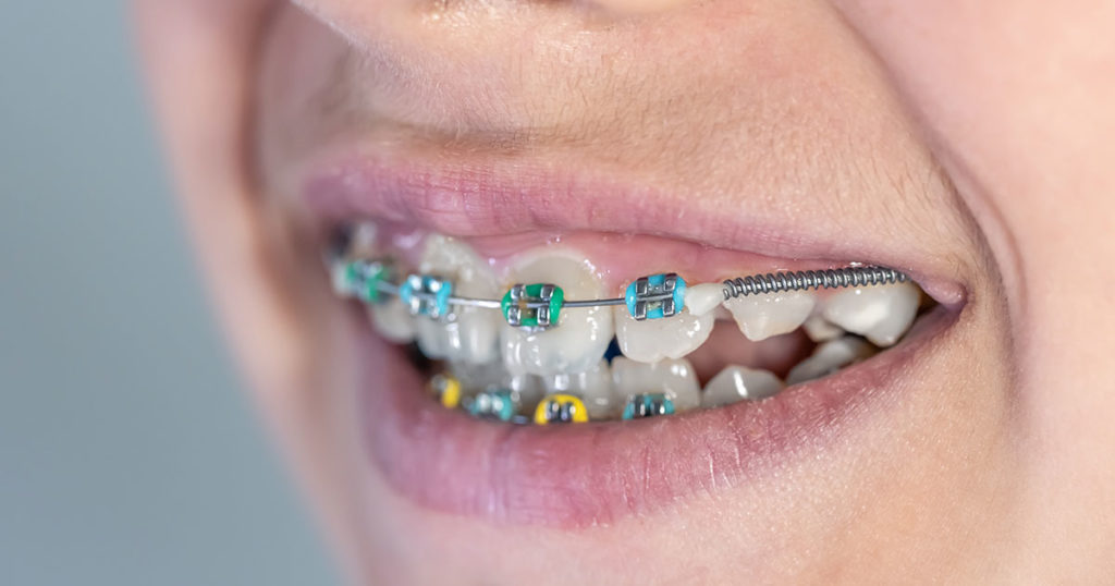 brackets