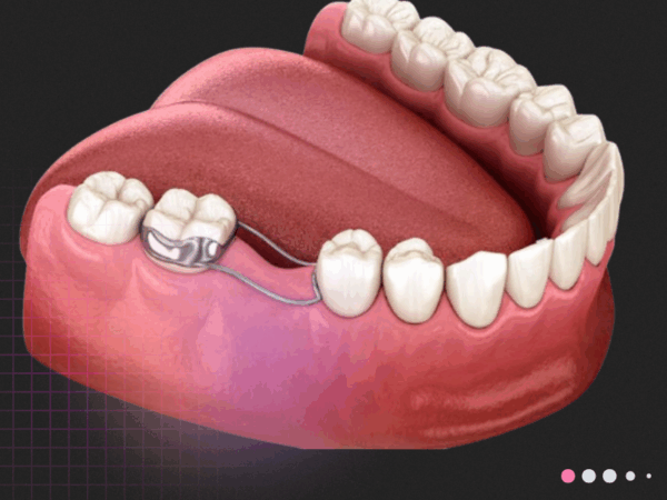 mantenedor de espacio dental