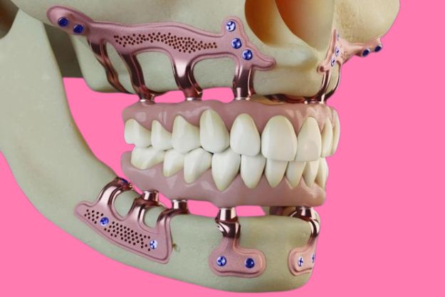 implantes subperiósticos