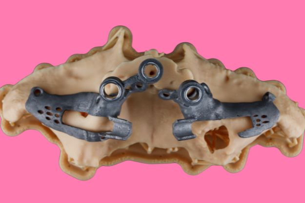 ejemplo de malla para colocación de implantes cigomáticos