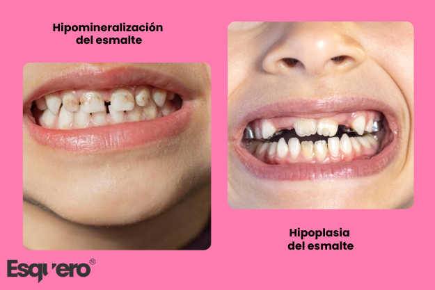 Displasia dental